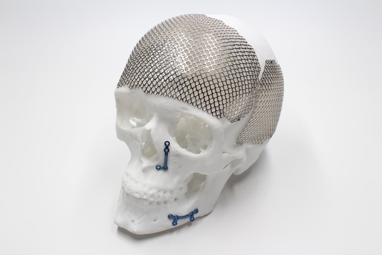 Patient-Specific Implant