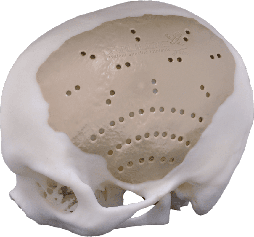 PEEK Implant