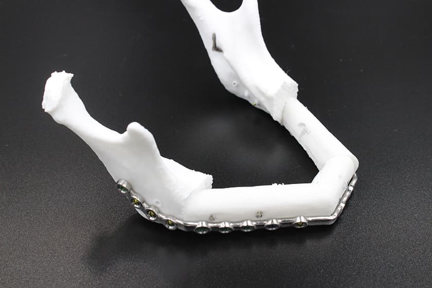 PSI Logic Maxfac: Mandibular Reconstruction