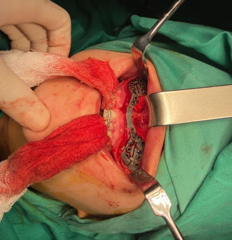 Logic Patient Specific Implant manufactured with SLM 3D printing for orthognathic surgery