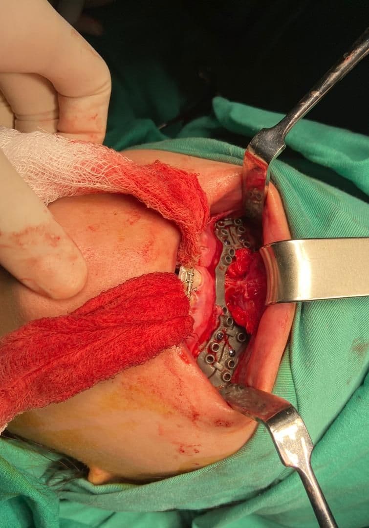 Precision orthognathic surgery cutting guides produced with Logic PSI technology