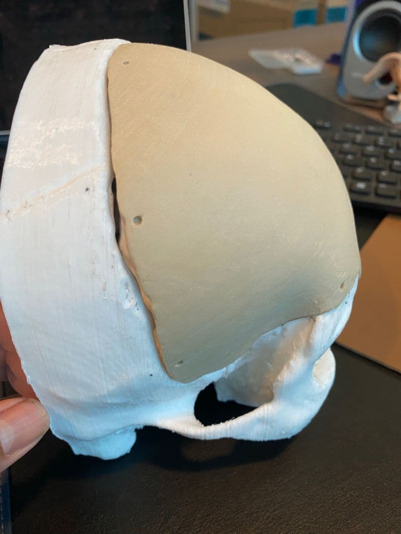 LOGIC PSI PEEK cranial implant fitted onto a 3D printed skull model, rear view