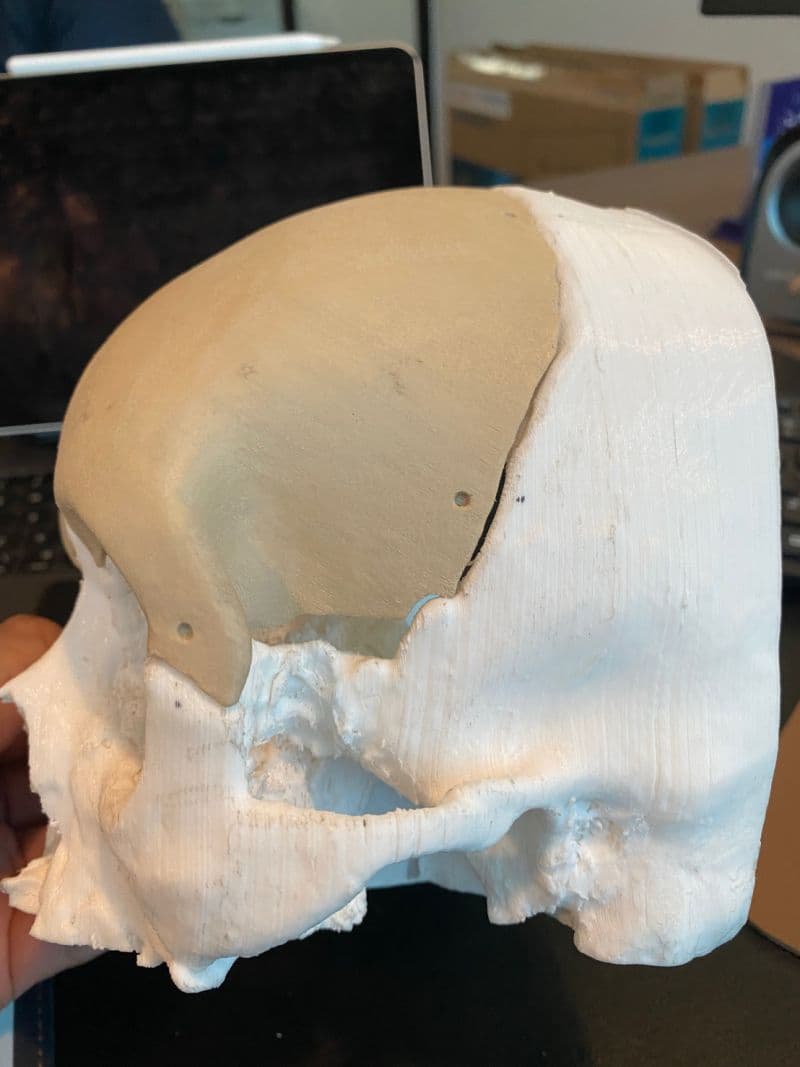 Patient-specific PEEK implant covering a large skull defect on a 3D printed anatomical model, side view