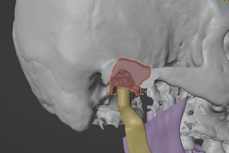 Logic PSI virtual surgical planning interface for TMJ ankylosis case