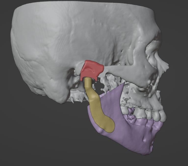 Looking for a precise and reliable way to surgically plan for temporomandibular joint (TMJ) ankylosi