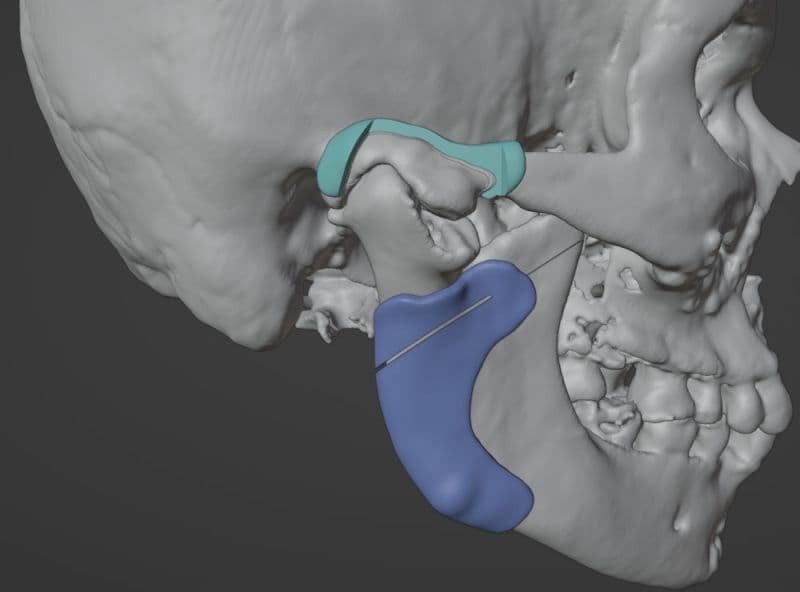 Patient-specific implant design for temporomandibular joint reconstruction