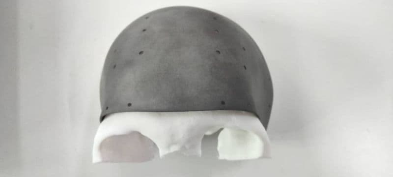 3D Gens bespoke titanium and PEEK 3D printed neuro maxillofacial surgical implants